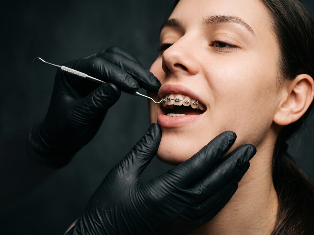 detalhe de ajuste de aparelho ortodôntico fixo com brackets e fio metálico visíveis